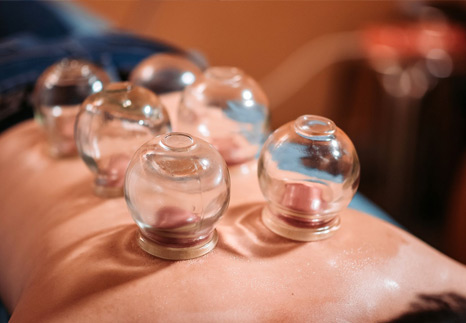 Cupping Therapy