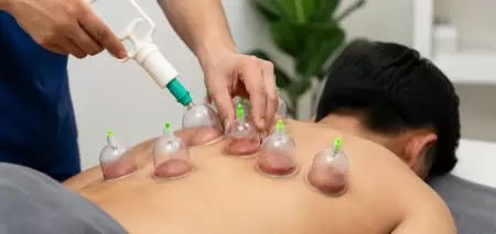 Cupping Therapy